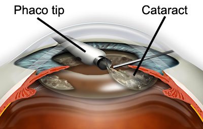 microphaco surgery treatment in Meerut